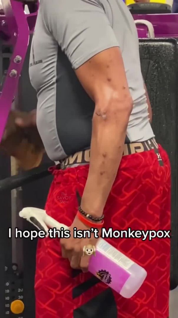 Pray this is not monkeypox